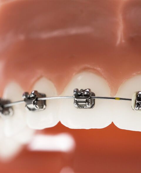 Specialty Ortho Braces