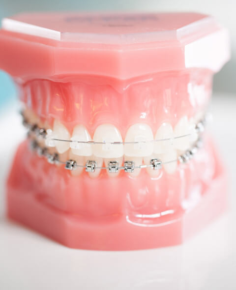 Specialty Ortho In-Ovation Braces